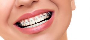 Braces – Non-extraction Straightwire Technique - Non-Extraction